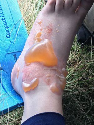 Manky foot :-/